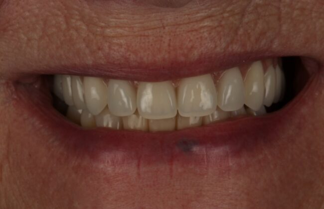 After (Teeth)