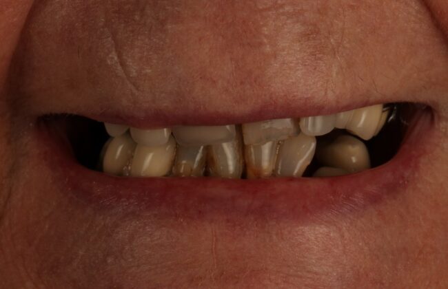 Before (Teeth)