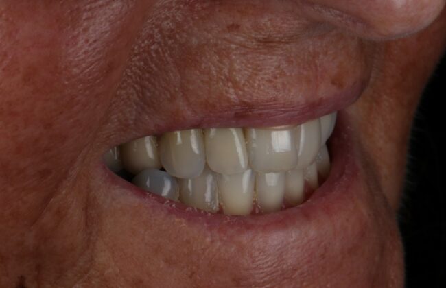 After (Teeth)
