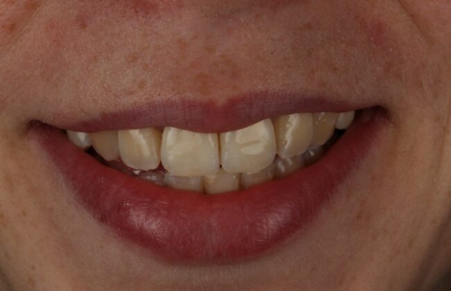 After (Teeth)