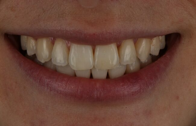 After (Teeth)