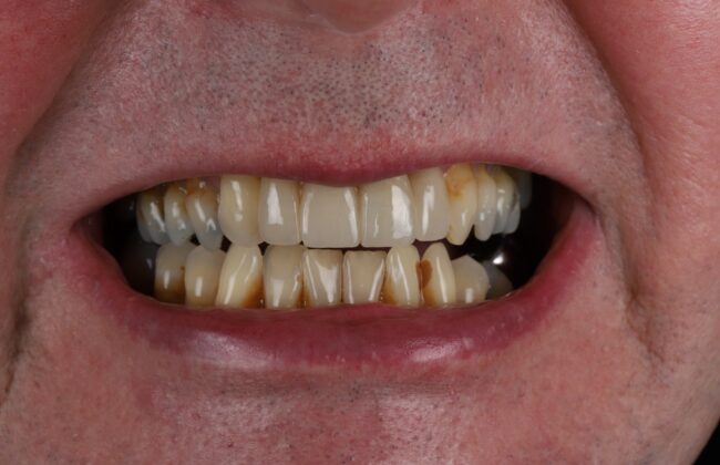 After (Teeth)