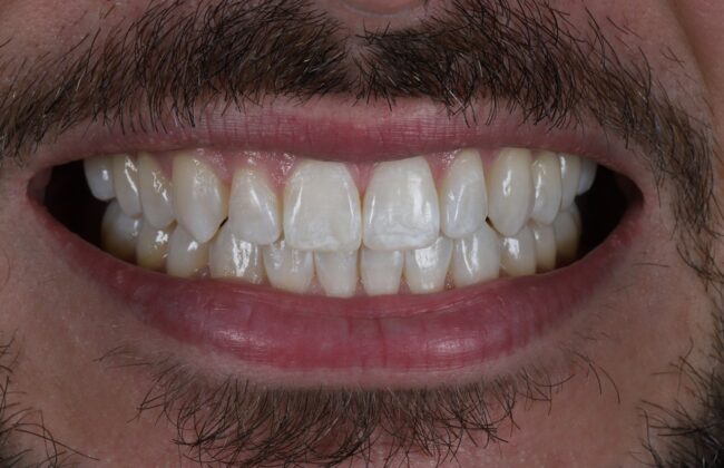 After (Teeth)