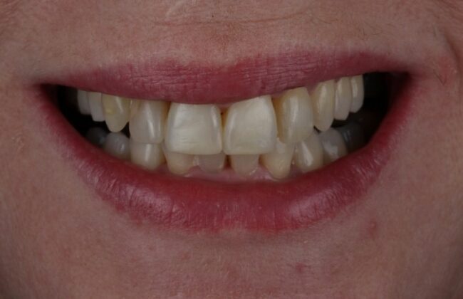 After (Teeth)