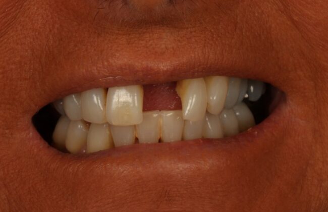 Before (Teeth)