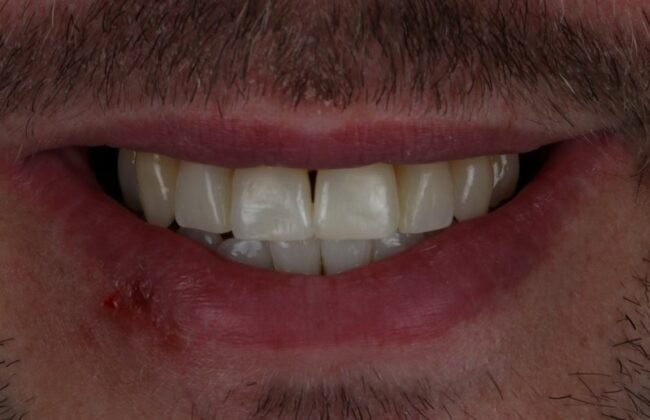 After (Teeth)