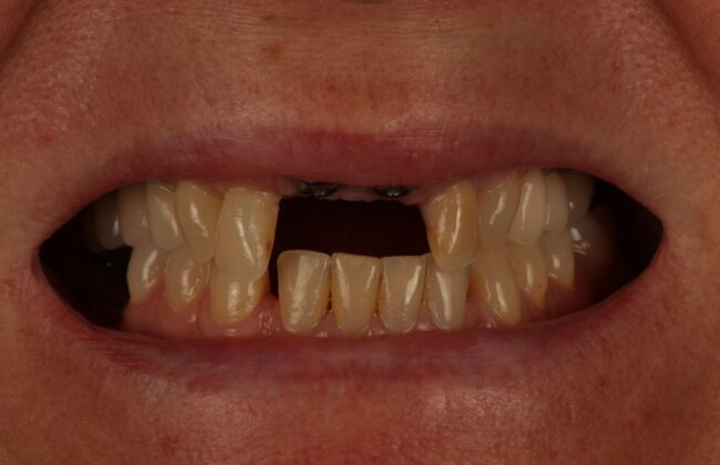 Before (Teeth)