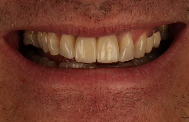 After (Teeth)