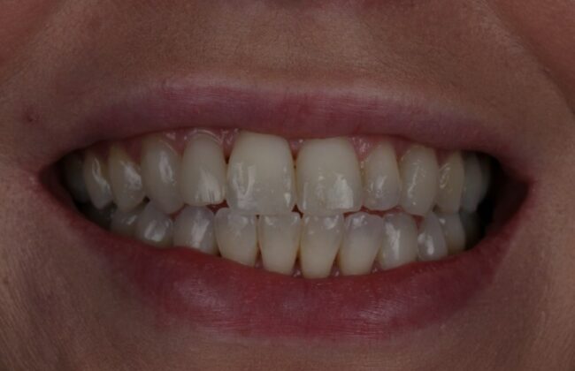 After (Teeth)