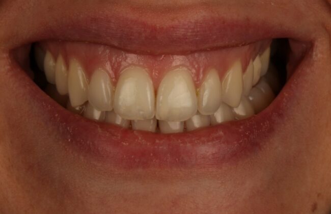 After (Teeth)