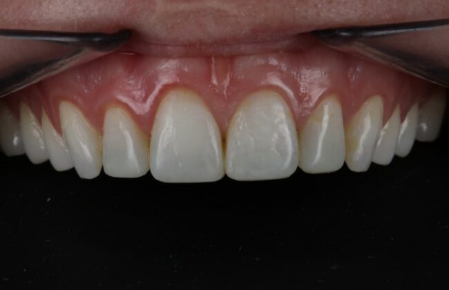 After (Teeth)