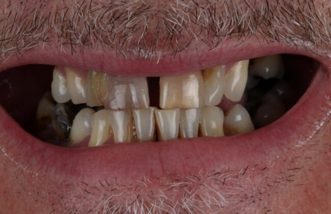 Before (Teeth)