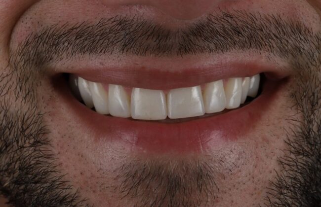 After (Teeth)