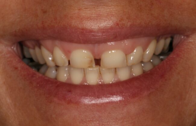 Before (Teeth)