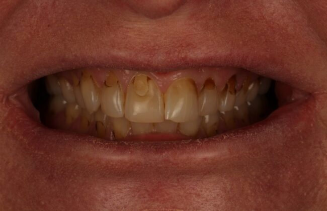 Before (Teeth)