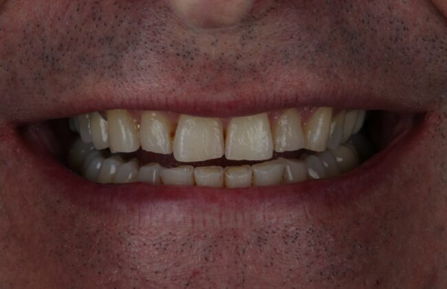 Before (Teeth)
