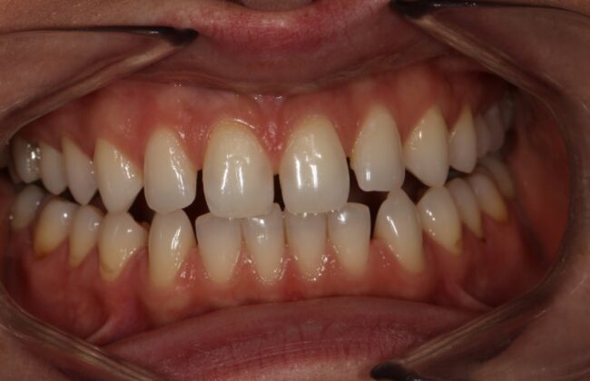 Before (Teeth)