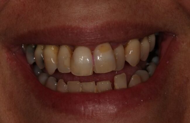 Before (Teeth)