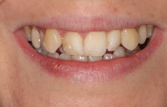 Before (Teeth)