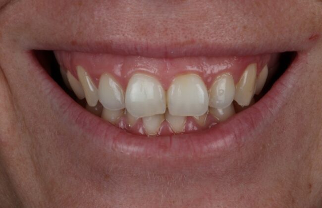 Before (Teeth)