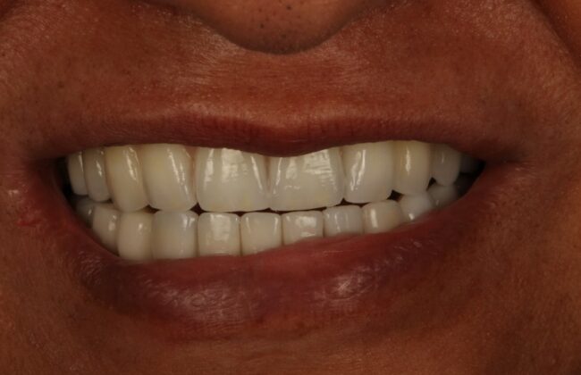 After (Teeth)