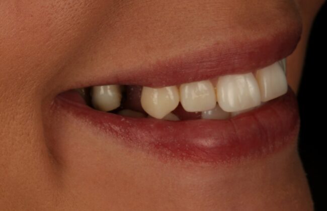 Before (Teeth)
