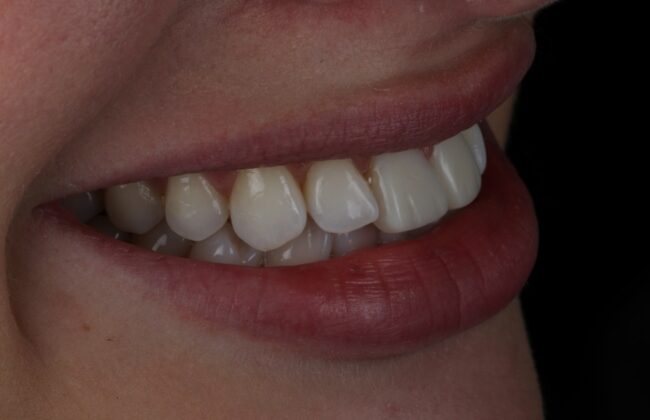 After (Teeth)