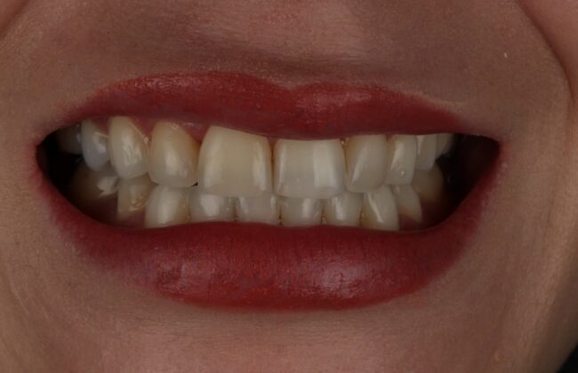 After (Teeth)