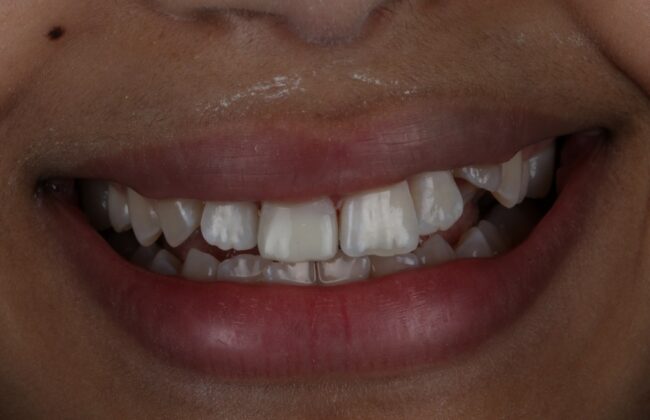 After (Teeth)