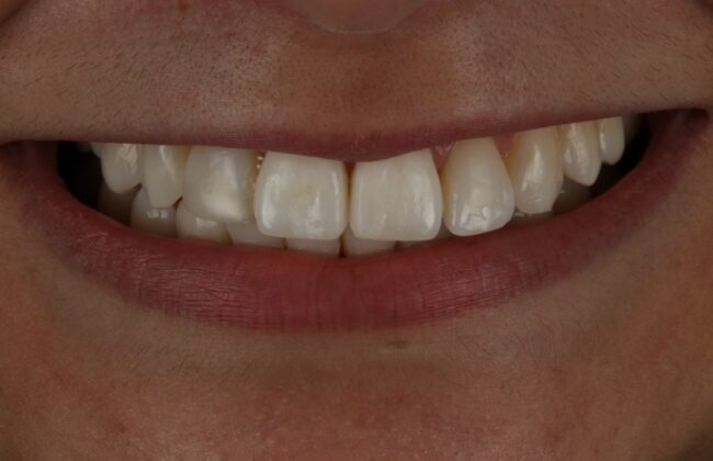 After (Teeth)