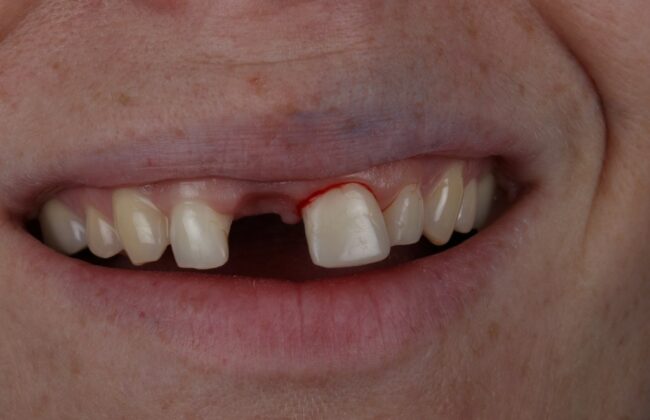 Before (Teeth)