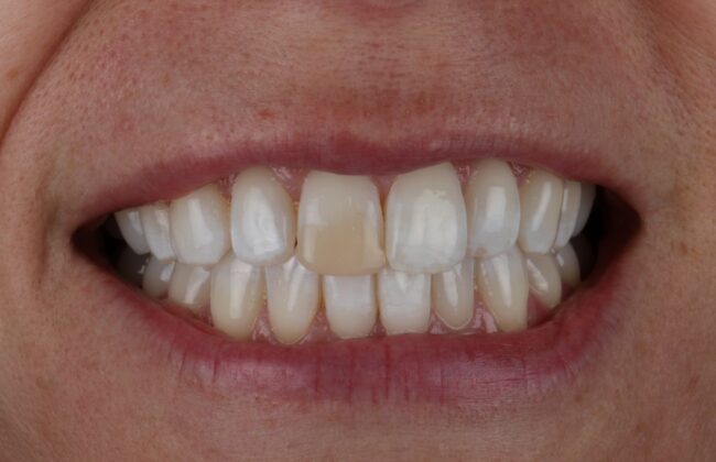 Before (Teeth)