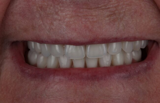 After (Teeth)