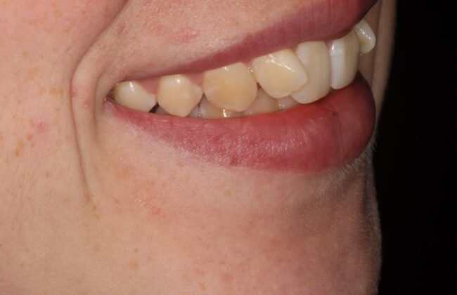 Before (Teeth)