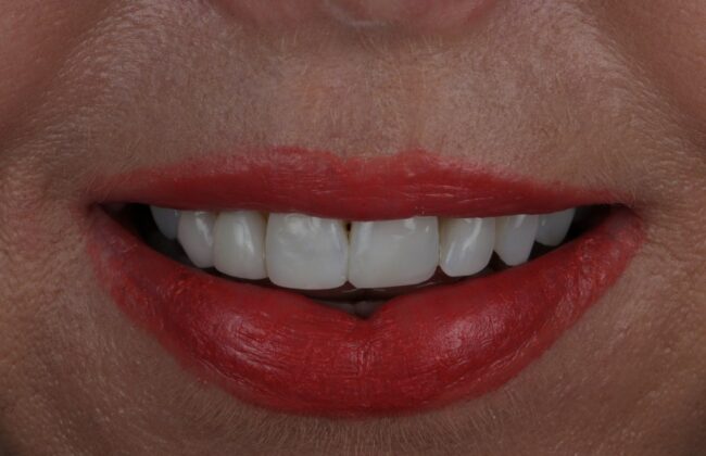 After (Teeth)