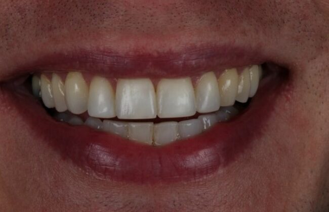 After (Teeth)