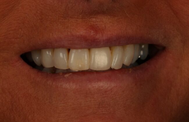 After (Teeth)