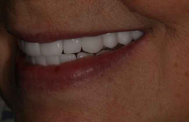After (Teeth)