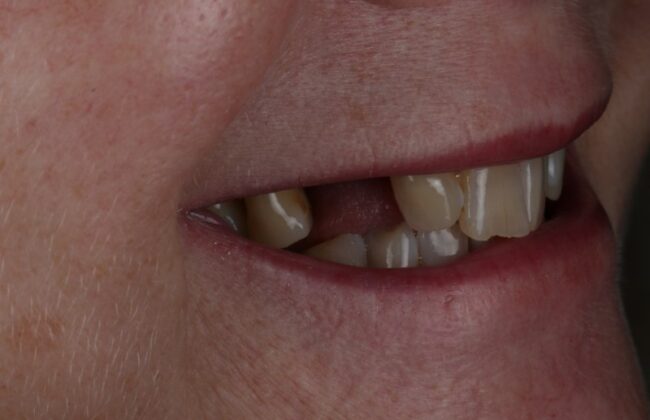 Before (Teeth)