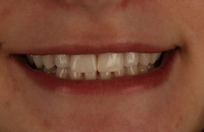 After (Teeth)