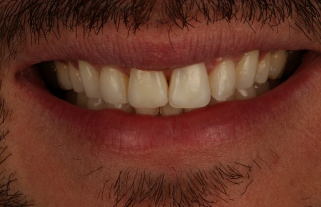After (Teeth)