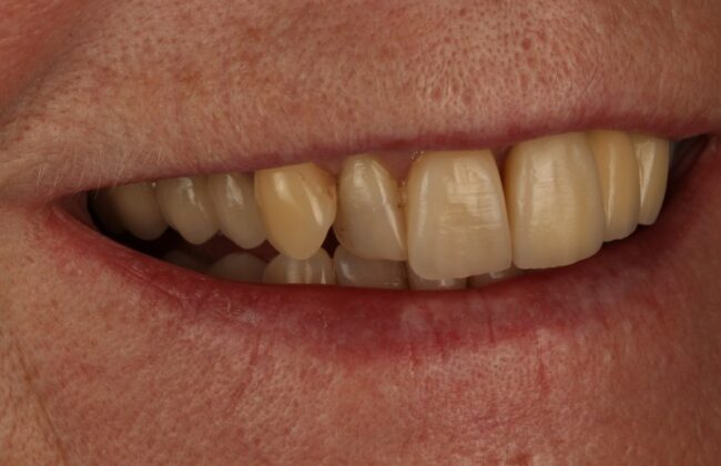 Before (Teeth)