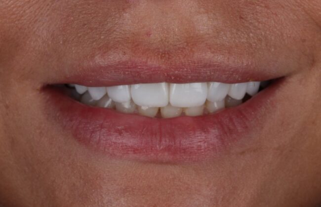 After (Teeth)