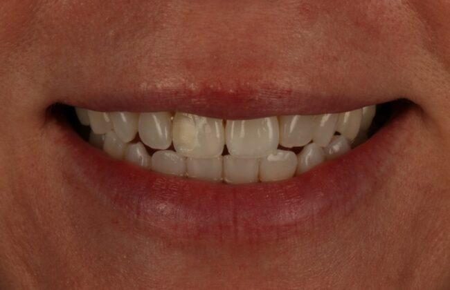 After (Teeth)