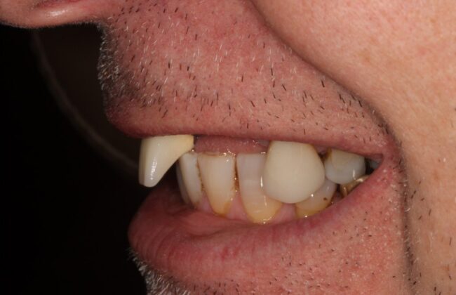 Before (Teeth)