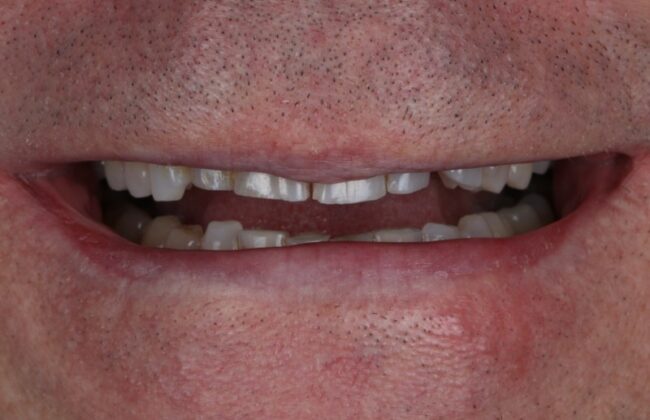 Before (Teeth)