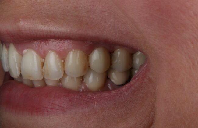 After (Teeth)