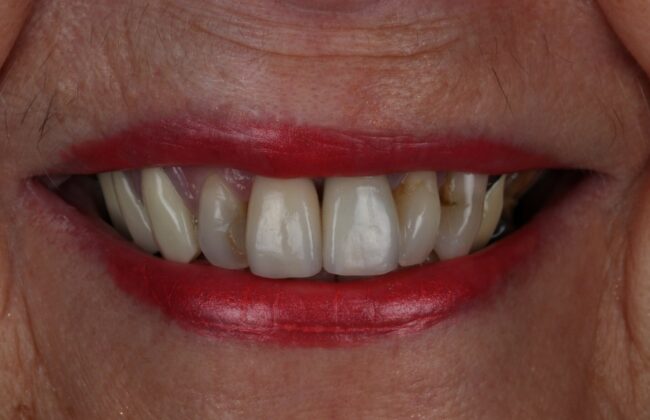 After (Teeth)