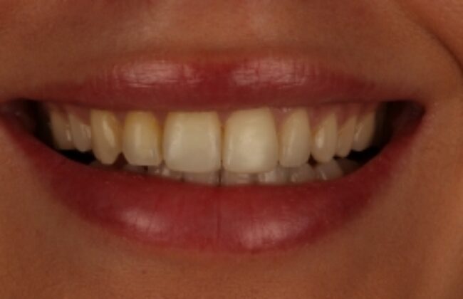 After (Teeth)