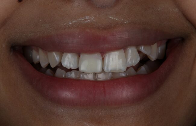 After (Teeth)